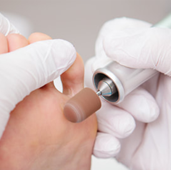 Feet Treatment - Callus